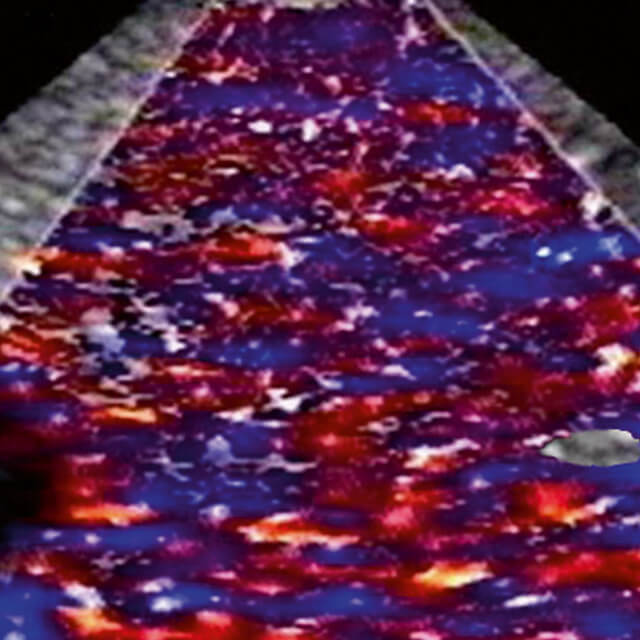 PolySon H Liver SAE Imaging